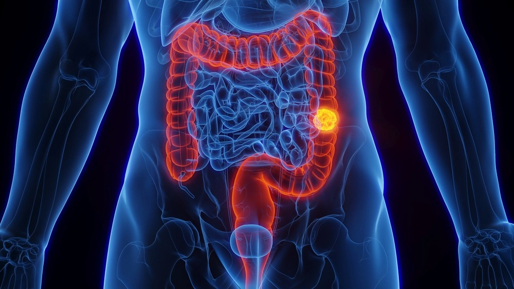 Câncer de intestino: brasileiros reconhecem sinais de alerta, mas não buscam atendimento