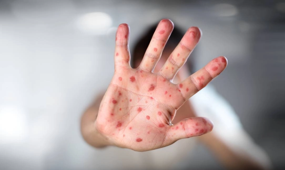 Bahia intensifica trabalhos da vigilância epidemiológica e vacinação para prevenir a reintrodução do sarampo
