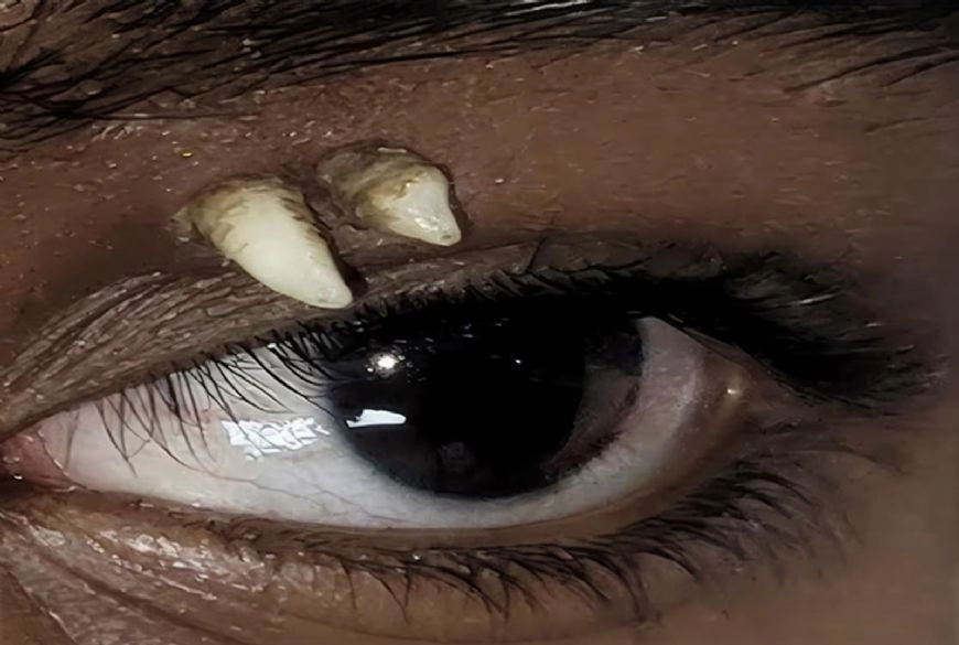 Dente cresce acima do olho em primeiro caso registrado pela ciência