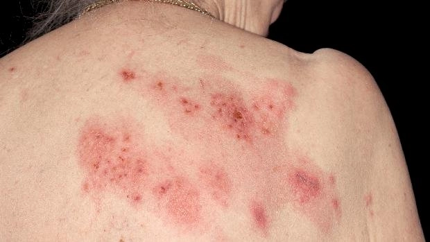 Canetas emagrecedoras e herpes: o alerta que vem de uma nova análise com milhares de usuários