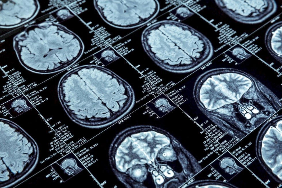 Pesquisadores desenvolvem método para prever Alzheimer antes dos primeiros sinais