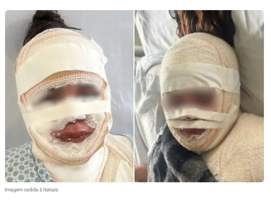 Fisioterapeuta joga água fervendo no rosto da atual do ex é presa em BH após novas ameaças
