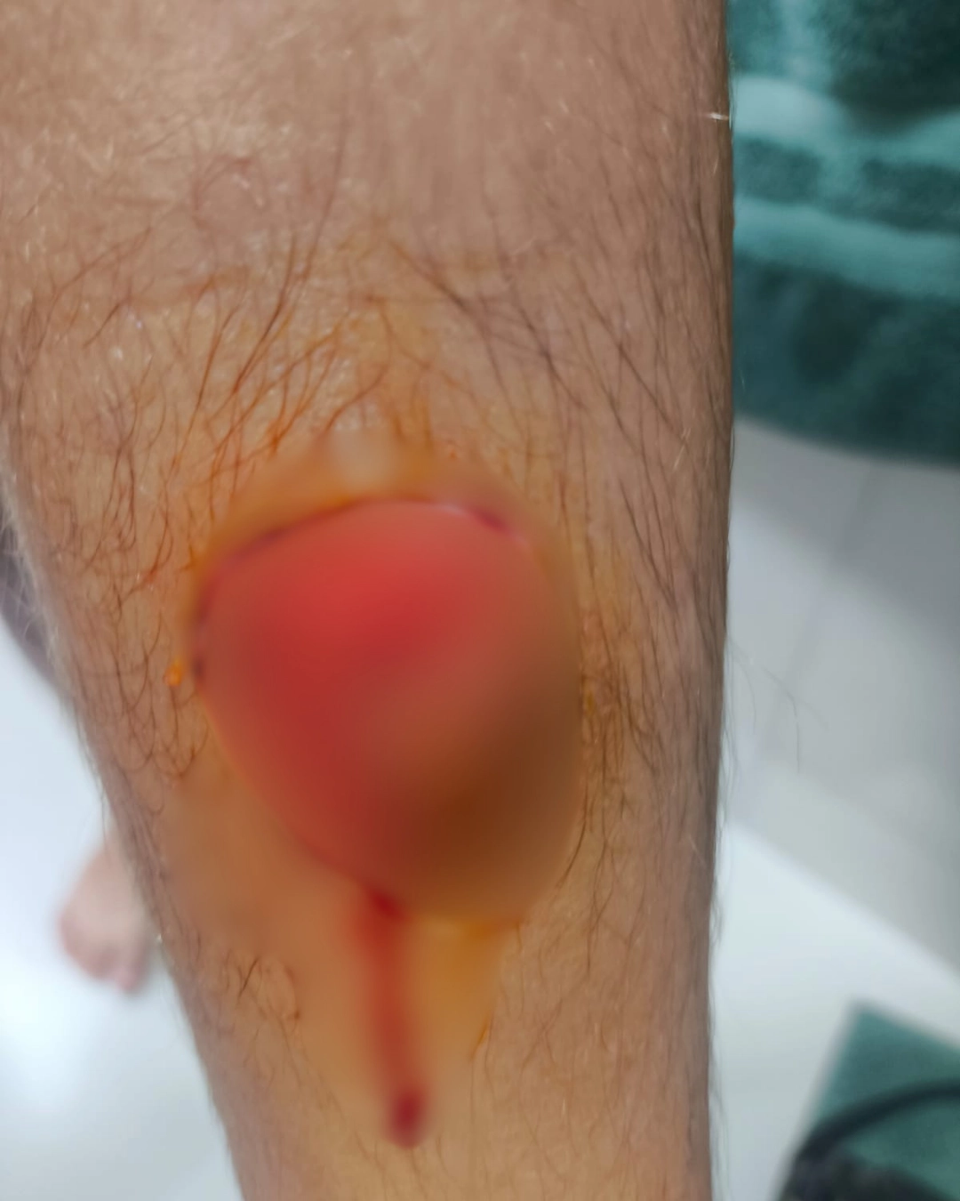 Menino de 11 anos é atacado por cães no Centro de Manhuaçu