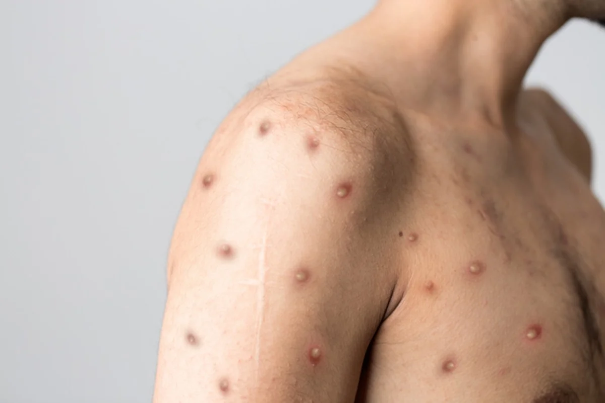 Rio de Janeiro registra 74 casos de Mpox em dois meses